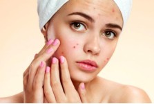 ACNE CARE