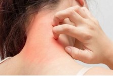 ECZEMA