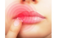 COLD SORES