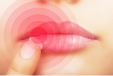 COLD SORES