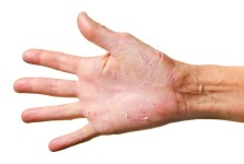 DRY SKIN