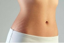 STRETCH MARKS