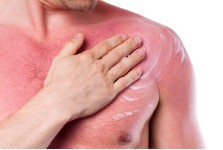 SUNBURN